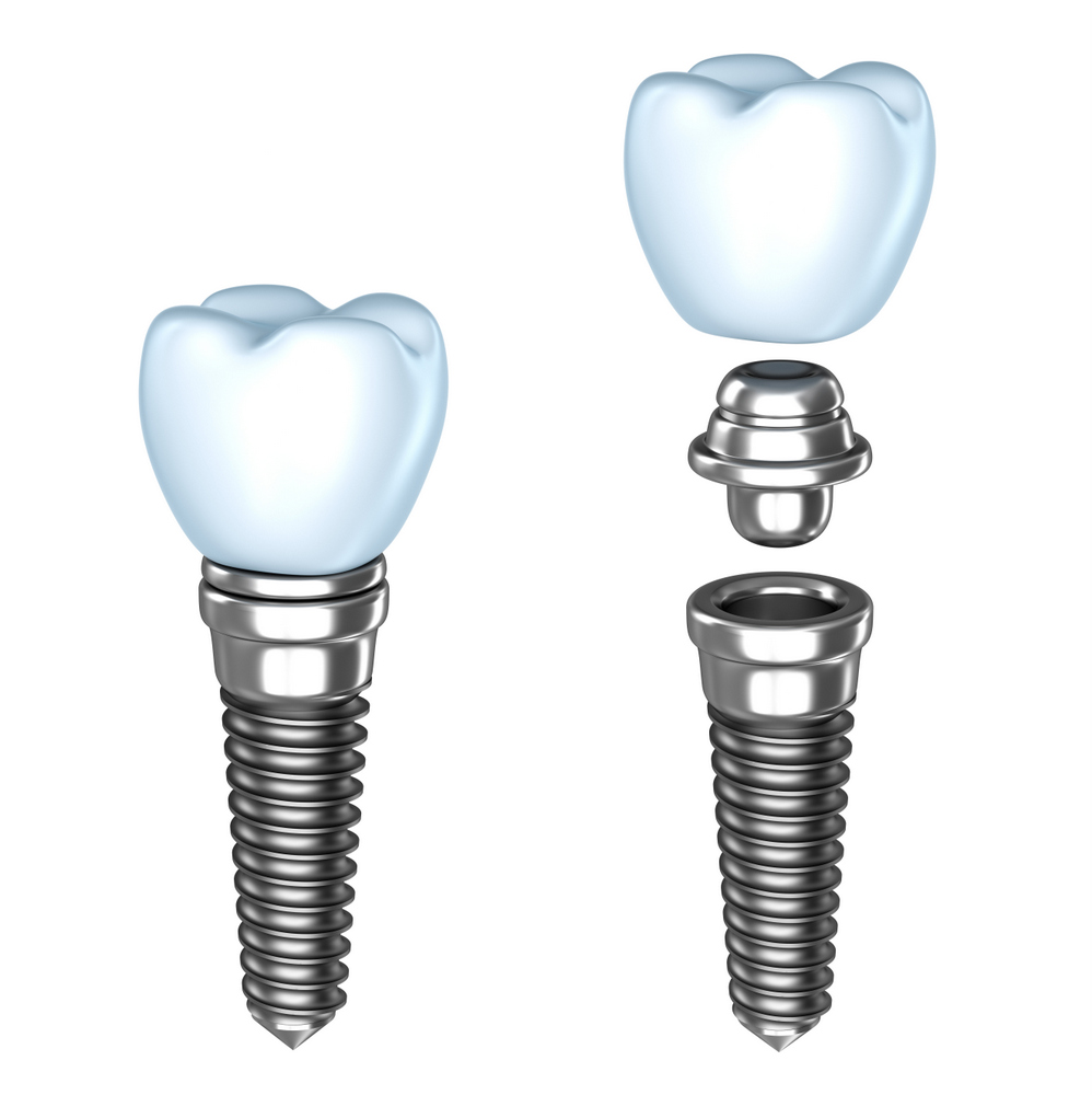 colton dental implant